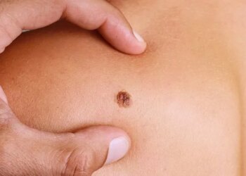 Metastatic Melanoma: Symptoms, Stages, Treatment