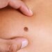 Metastatic Melanoma: Symptoms, Stages, Treatment